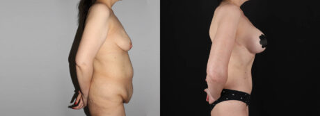 Post Bariatric Surgery (Massive Weight Loss) case #6771