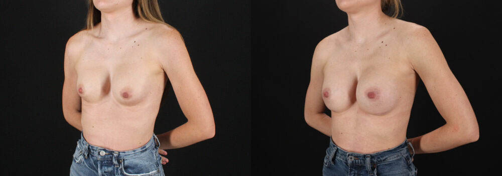 Revision Breast Surgery case #256261