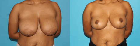 Breast Reduction case #7939