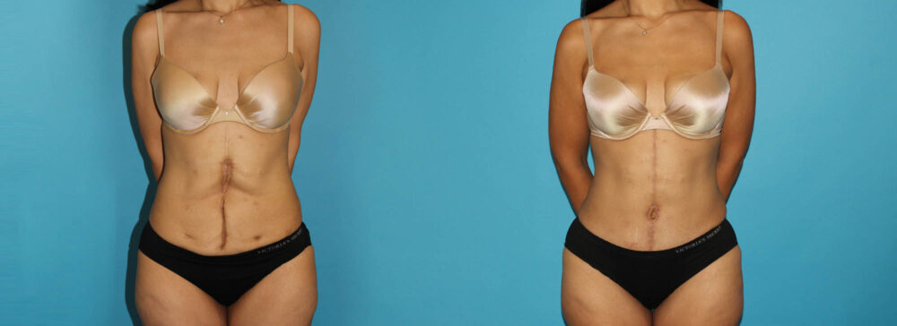 Post Bariatric Surgery (Massive Weight Loss) case #6775