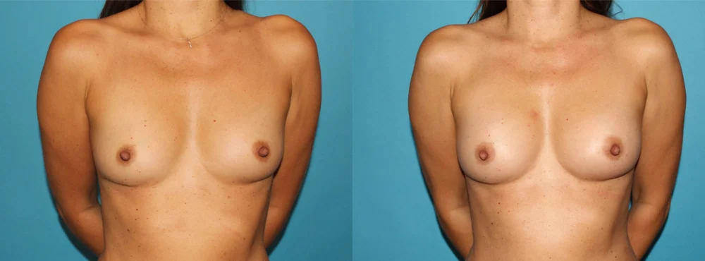 Fat Grafting to the Breast case #256155