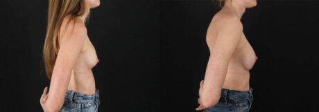 Revision Breast Surgery case #256261