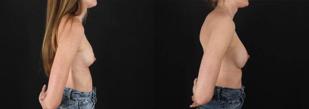 Revision Breast Surgery case #256261