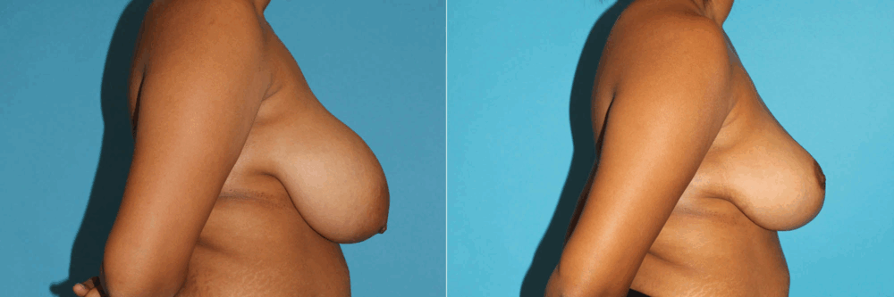 Breast Reduction case #7939