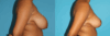 Breast Reduction case #7939 slider thumbnail