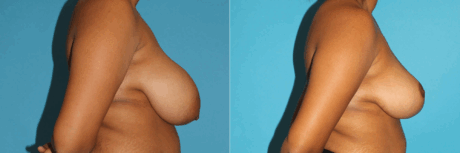 Breast Reduction case #7939