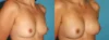 Fat Grafting to the Breast case #256155 slider thumbnail