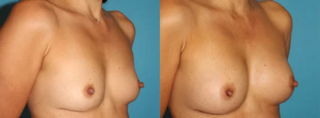Fat Grafting to the Breast case #256155
