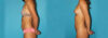 Liposuction case #5889 slider thumbnail