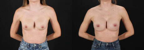 Revision Breast Surgery case #256261