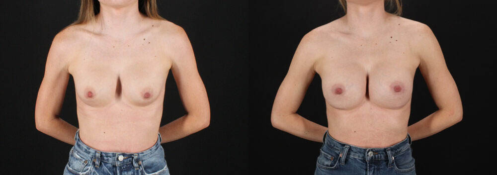 Revision Breast Surgery case #256261