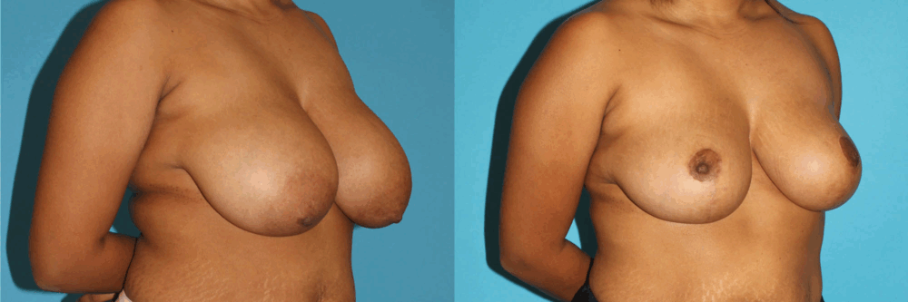 Breast Reduction case #7939