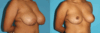 Breast Reduction case #7939 slider thumbnail