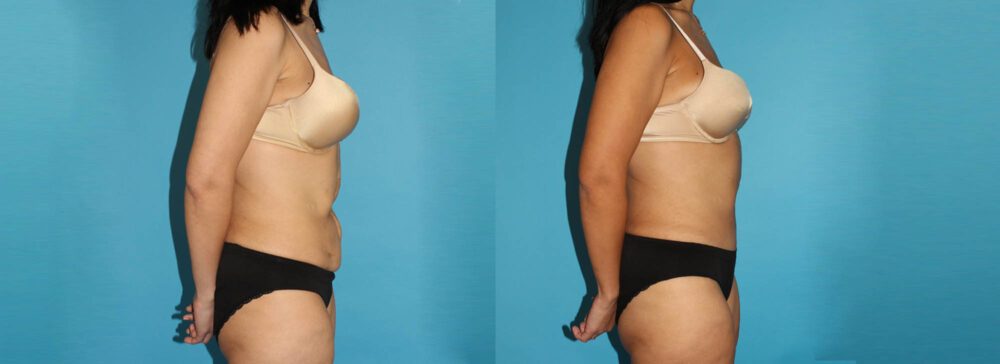 Post Bariatric Surgery (Massive Weight Loss) case #6775