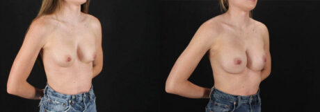 Revision Breast Surgery case #256261