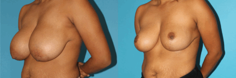 Breast Reduction case #7939