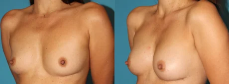 Fat Grafting to the Breast case #256155