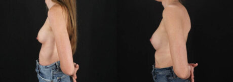 Revision Breast Surgery case #256261