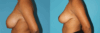 Breast Reduction case #7939 slider thumbnail
