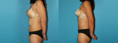 Post Bariatric Surgery (Massive Weight Loss) case #6775