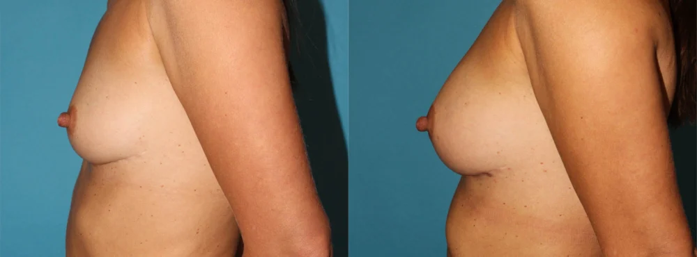 Fat Grafting to the Breast case #256155