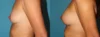 Fat Grafting to the Breast case #256155 slider thumbnail