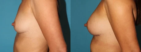 Fat Grafting to the Breast case #256155