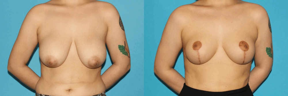 Breast Reduction case #7956