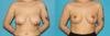 Breast Reduction case #7956 slider thumbnail