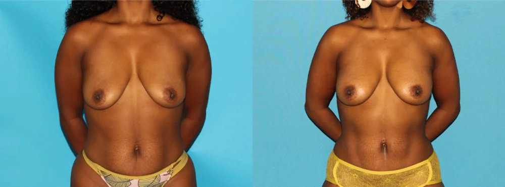 Fat Grafting to the Breast case #256147