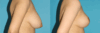 Breast Reduction case #7956 slider thumbnail