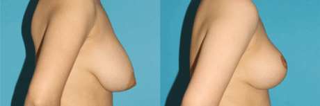 Breast Reduction case #7956