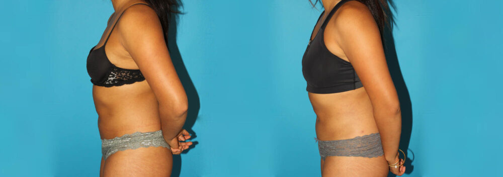 Liposuction case #5890