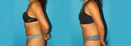 Liposuction case #5890