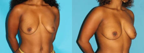 Fat Grafting to the Breast case #256147