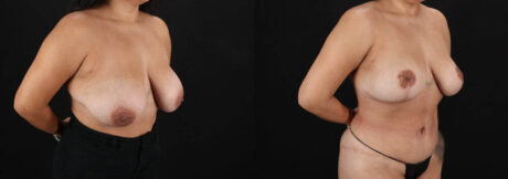 Revision Breast Surgery case #256274