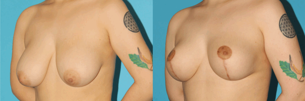 Breast Reduction case #7956