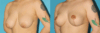 Breast Reduction case #7956 slider thumbnail
