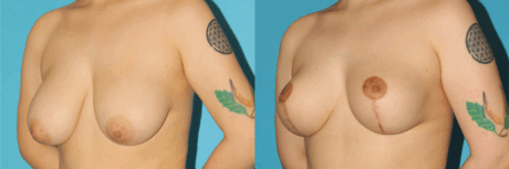 Breast Reduction case #7956