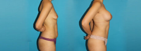 Post Bariatric Surgery (Massive Weight Loss) case #6777