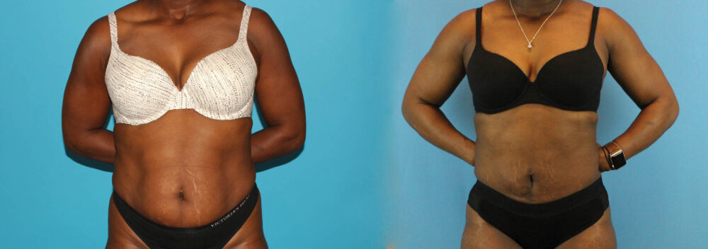 Liposuction case #5891