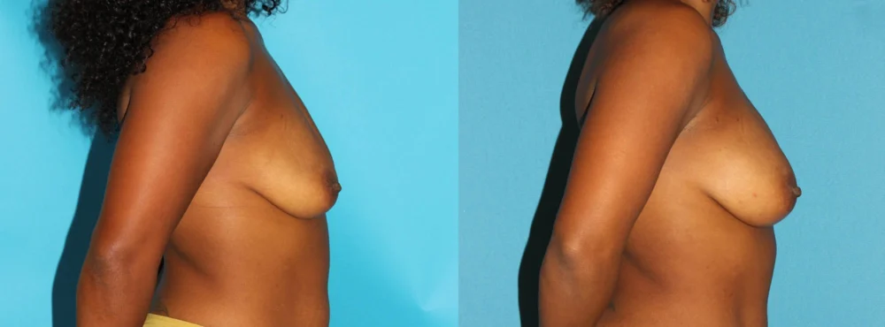 Fat Grafting to the Breast case #256147