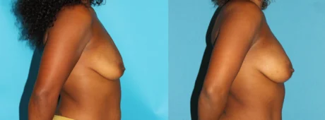 Fat Grafting to the Breast case #256147