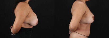 Revision Breast Surgery case #256274