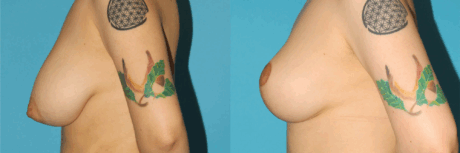 Breast Reduction case #7956