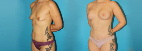 Post Bariatric Surgery (Massive Weight Loss) case #6777