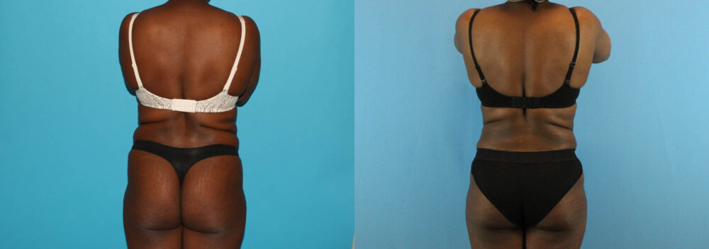 Liposuction case #5891