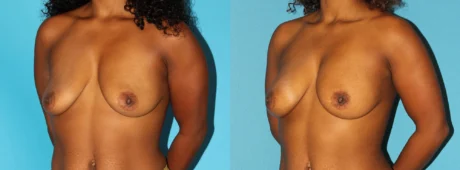 Fat Grafting to the Breast case #256147