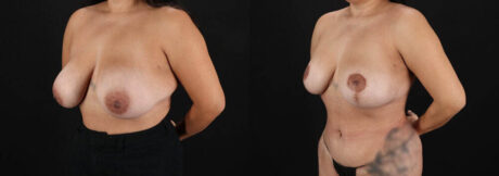 Revision Breast Surgery case #256274
