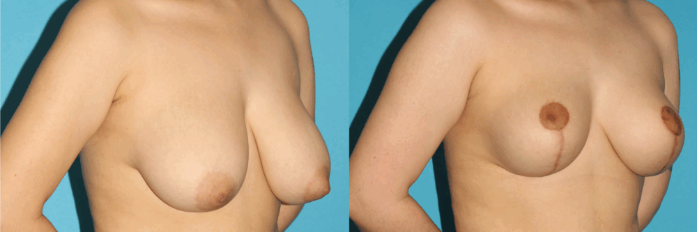 Breast Reduction case #7956